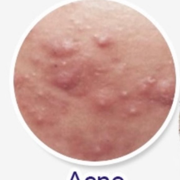 Anti acne whitening soap - Picture 6 of 7